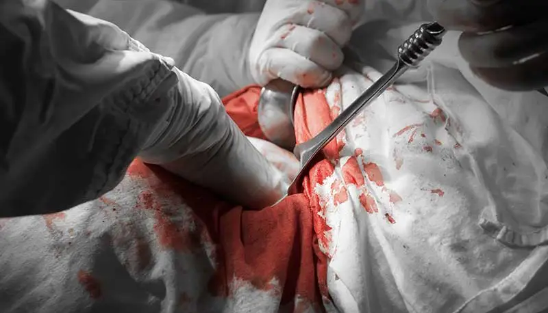 cirugía abierta, litiasis renal, dr edgar beltrán, urólogo, cdmx